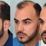 Man met weinig haar